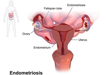 Endometriosis-4