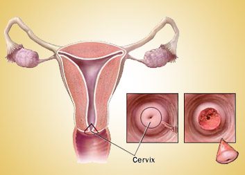 cervical-conization-2