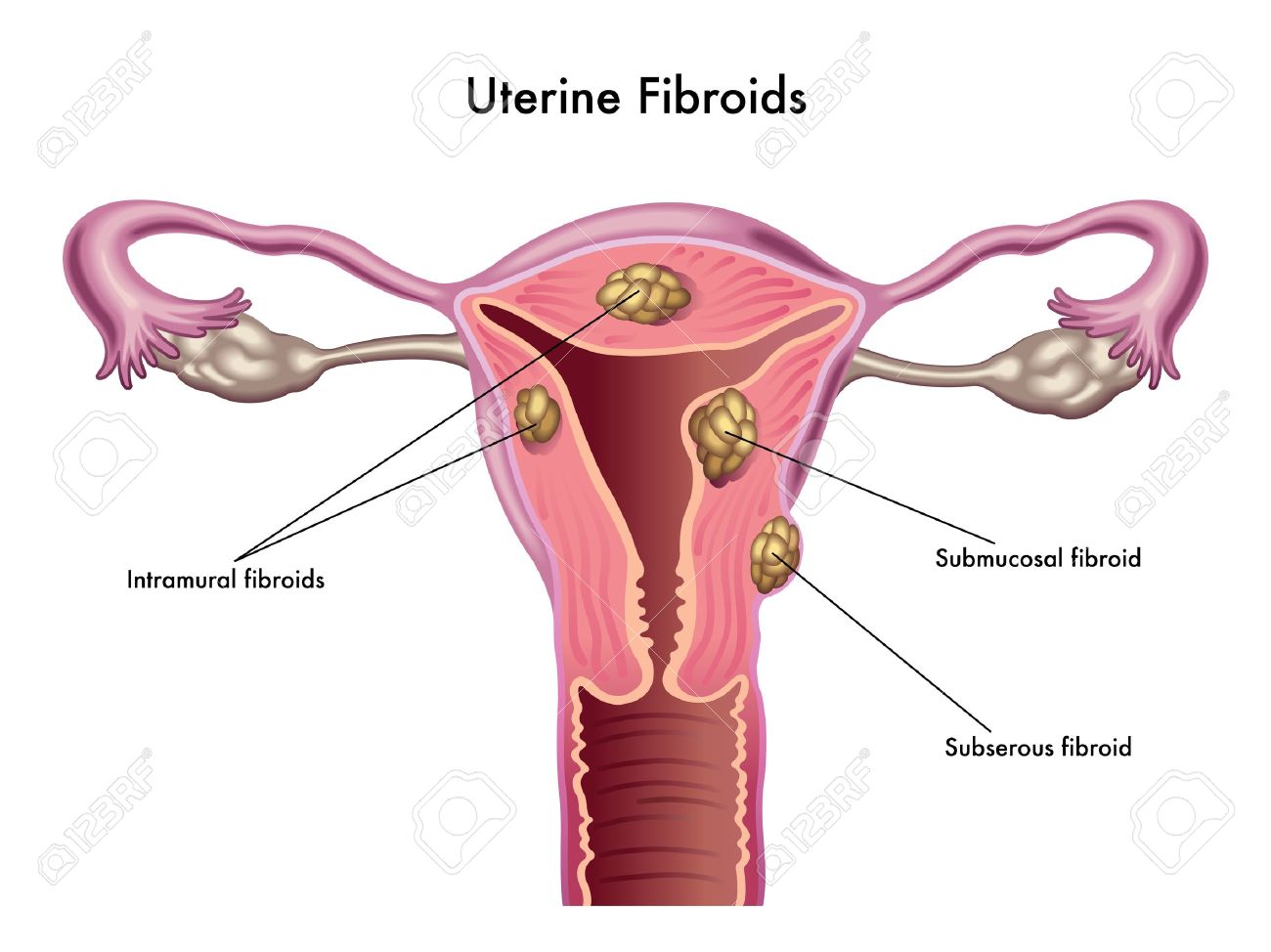 16456220-uterine-fibroids-fibroid