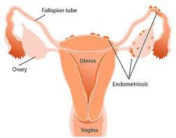 who-is-affected-by-endometriosis-1